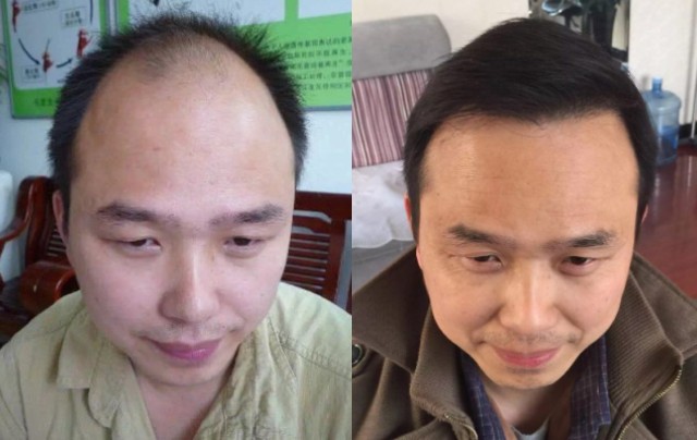 singapore hair loss prevention