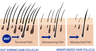 DHT shirnk hair follicle