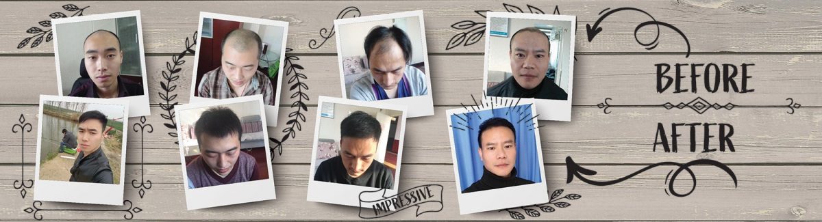 hair loss prevention services