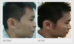 hair restoration services singapore