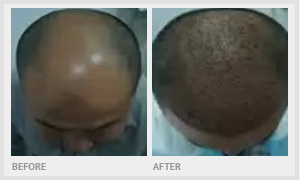 before and after hair implants singapore