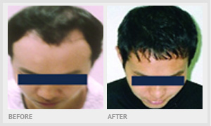 before and after hair implant
