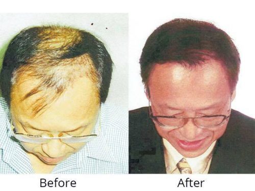 hair restoration company