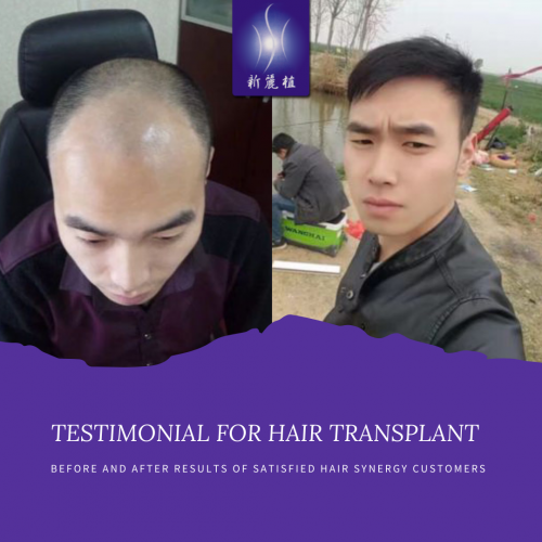 hair transplant services in Singapore